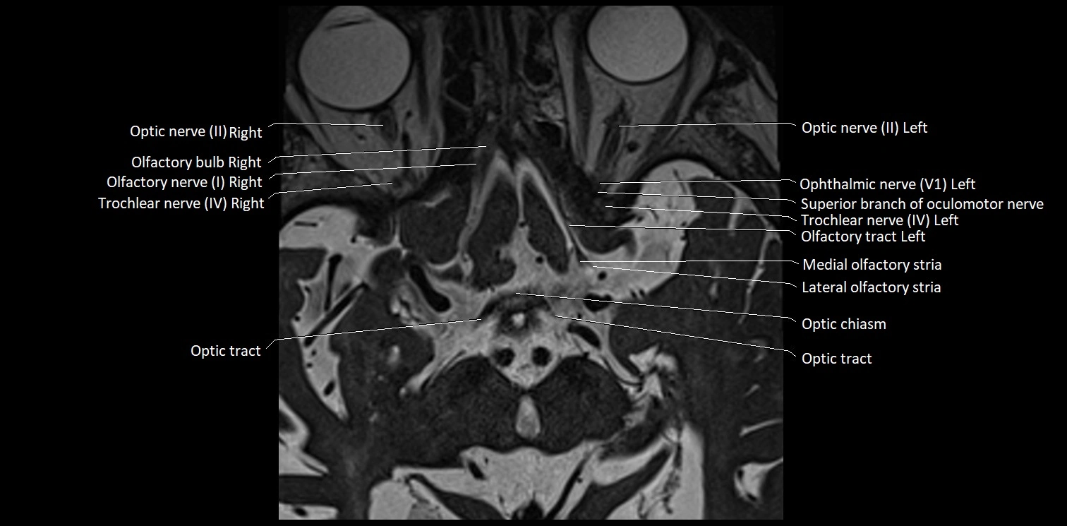 Cranial nerve anatomy axial MRI 3T image 9.webp